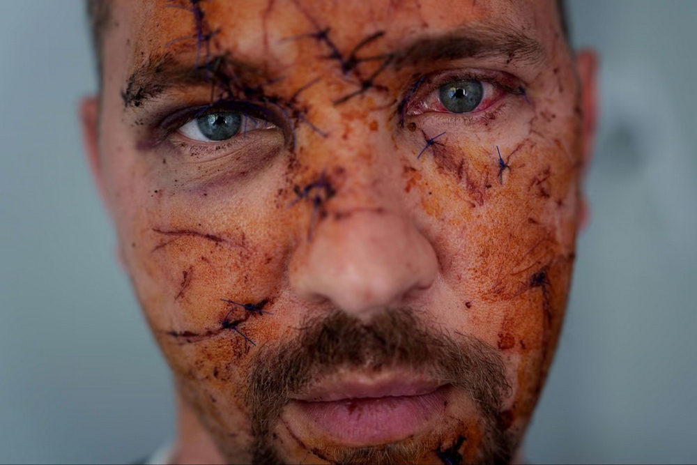 سرباز اوکراینی که جراحات زیادی در چهره اش بر اثر جنگ با روسیه نمایان است